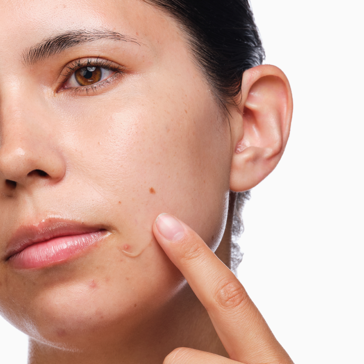 The Acne Set V1 image 8